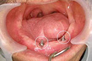 症例4 インプラント総入れ歯