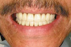 症例4 インプラント総入れ歯
