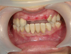 症例6 前歯部インプラント