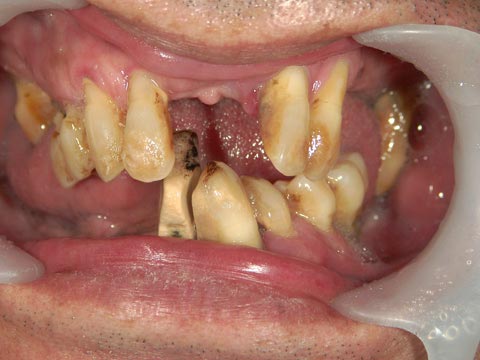 症例8 上下顎インプラント